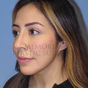 A oblique view after photo of patient 4126 that underwent Rhinoplasty:Septoplasty procedures at Memorial Plastic Surgery