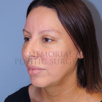 A oblique view before photo of patient 4125 that underwent Rhinoplasty:Septoplasty procedures at Memorial Plastic Surgery