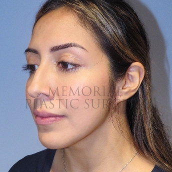 A oblique view before photo of patient 4126 that underwent Rhinoplasty:Septoplasty procedures at Memorial Plastic Surgery