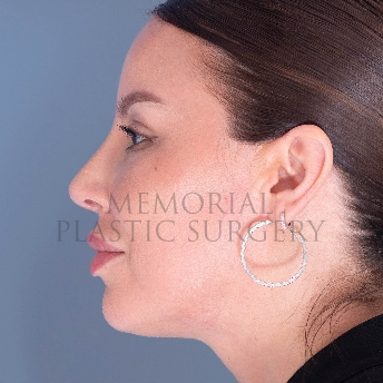 A side view after photo of patient 4125 that underwent Rhinoplasty:Septoplasty procedures at Memorial Plastic Surgery