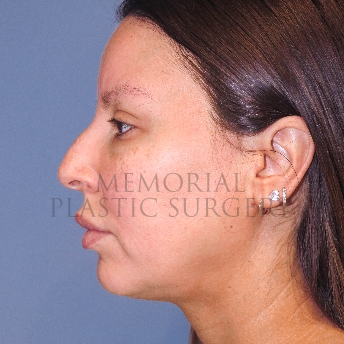 A side view before photo of patient 4125 that underwent Rhinoplasty:Septoplasty procedures at Memorial Plastic Surgery