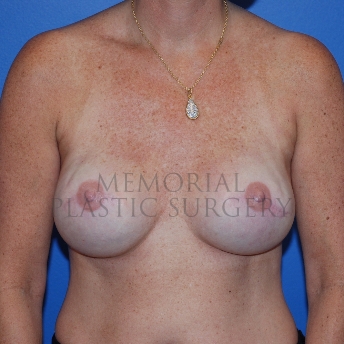 A front view after photo of patient 773 that underwent Tissue Expander Implant procedures at Memorial Plastic Surgery