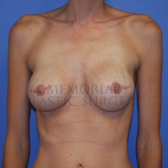 A front view after photo of patient 770 that underwent Tissue Expander Implant procedures at Memorial Plastic Surgery