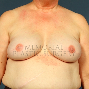 A front view after photo of patient 241 that underwent Tissue Expander Implant procedures at Memorial Plastic Surgery
