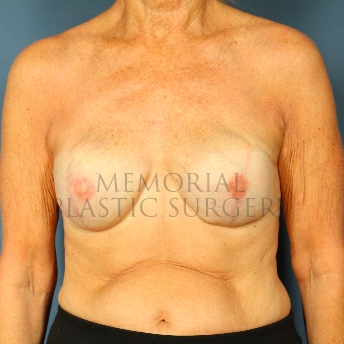 A front view after photo of patient 242 that underwent Tissue Expander Implant procedures at Memorial Plastic Surgery