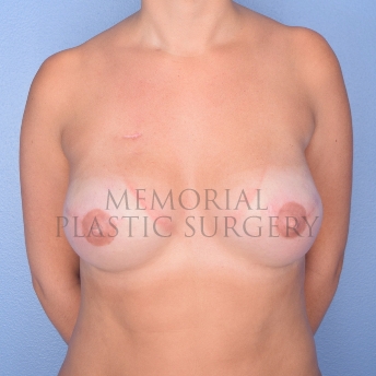 A front view after photo of patient 771 that underwent Tissue Expander Implant procedures at Memorial Plastic Surgery