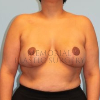 A front view after photo of patient 193 that underwent Tissue Expander Implant procedures at Memorial Plastic Surgery