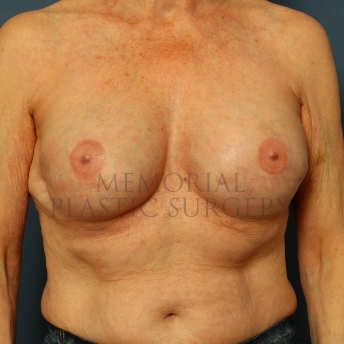 A front view after photo of patient 239 that underwent Tissue Expander Implant procedures at Memorial Plastic Surgery