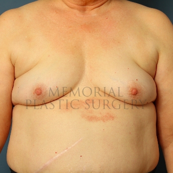 A front view before photo of patient 241 that underwent Tissue Expander Implant procedures at Memorial Plastic Surgery
