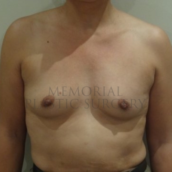 A front view before photo of patient 202 that underwent Tissue Expander Implant procedures at Memorial Plastic Surgery