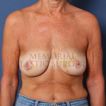 A front view before photo of patient 242 that underwent Tissue Expander Implant procedures at Memorial Plastic Surgery