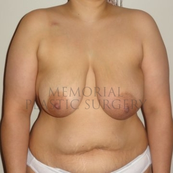 A front view before photo of patient 193 that underwent Tissue Expander Implant procedures at Memorial Plastic Surgery