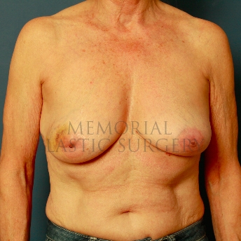 A front view before photo of patient 239 that underwent Tissue Expander Implant procedures at Memorial Plastic Surgery