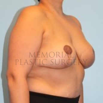 A oblique view after photo of patient 193 that underwent Tissue Expander Implant procedures at Memorial Plastic Surgery