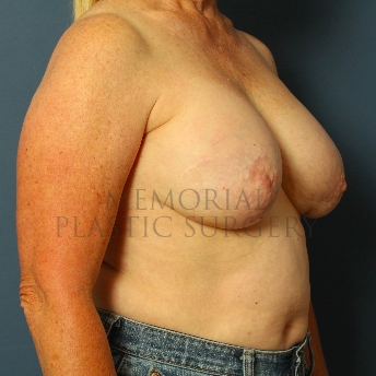 A oblique view before photo of patient 240 that underwent Tissue Expander Implant procedures at Memorial Plastic Surgery