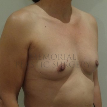 A oblique view before photo of patient 202 that underwent Tissue Expander Implant procedures at Memorial Plastic Surgery