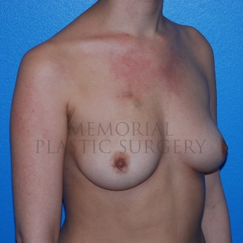 A oblique view before photo of patient 771 that underwent Tissue Expander Implant procedures at Memorial Plastic Surgery