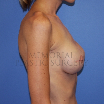 A side view after photo of patient 770 that underwent Tissue Expander Implant procedures at Memorial Plastic Surgery