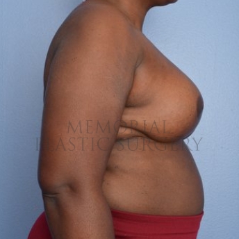 A side view after photo of patient 294 that underwent Tissue Expander Implant procedures at Memorial Plastic Surgery