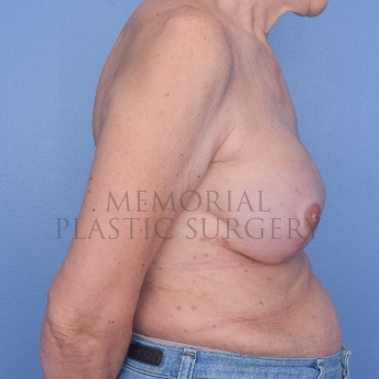 A side view after photo of patient 747 that underwent Tissue Expander Implant procedures at Memorial Plastic Surgery