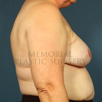 A side view after photo of patient 241 that underwent Tissue Expander Implant procedures at Memorial Plastic Surgery