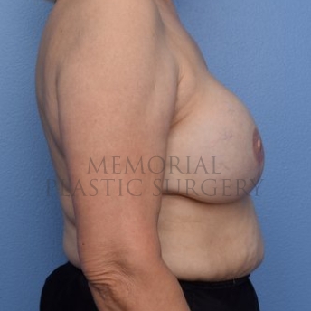 A side view after photo of patient 295 that underwent Tissue Expander Implant procedures at Memorial Plastic Surgery