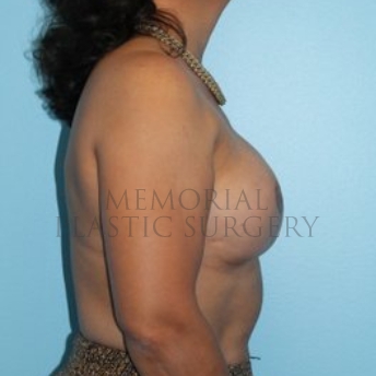 A side view after photo of patient 202 that underwent Tissue Expander Implant procedures at Memorial Plastic Surgery