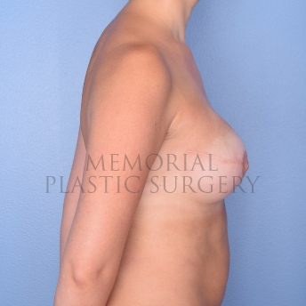 A side view after photo of patient 771 that underwent Tissue Expander Implant procedures at Memorial Plastic Surgery