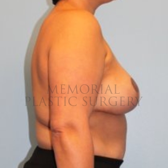 A side view after photo of patient 193 that underwent Tissue Expander Implant procedures at Memorial Plastic Surgery