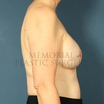 A side view after photo of patient 243 that underwent Tissue Expander Implant procedures at Memorial Plastic Surgery