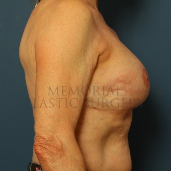 A side view after photo of patient 239 that underwent Tissue Expander Implant procedures at Memorial Plastic Surgery