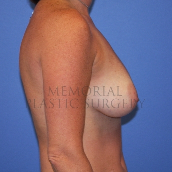 A side view before photo of patient 773 that underwent Tissue Expander Implant procedures at Memorial Plastic Surgery