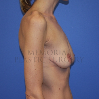 A side view before photo of patient 770 that underwent Tissue Expander Implant procedures at Memorial Plastic Surgery