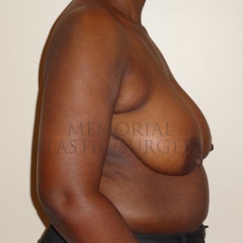 A side view before photo of patient 294 that underwent Tissue Expander Implant procedures at Memorial Plastic Surgery