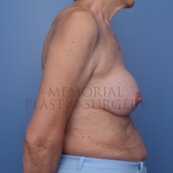 A side view before photo of patient 747 that underwent Tissue Expander Implant procedures at Memorial Plastic Surgery
