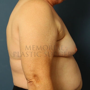 A side view before photo of patient 241 that underwent Tissue Expander Implant procedures at Memorial Plastic Surgery