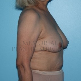 A side view before photo of patient 295 that underwent Tissue Expander Implant procedures at Memorial Plastic Surgery