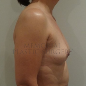 A side view before photo of patient 202 that underwent Tissue Expander Implant procedures at Memorial Plastic Surgery
