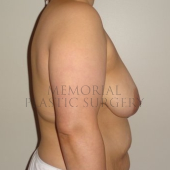 A side view before photo of patient 193 that underwent Tissue Expander Implant procedures at Memorial Plastic Surgery