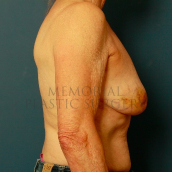 A side view before photo of patient 239 that underwent Tissue Expander Implant procedures at Memorial Plastic Surgery