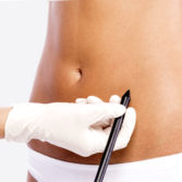 vaser lysonix ultrasonic liposuction