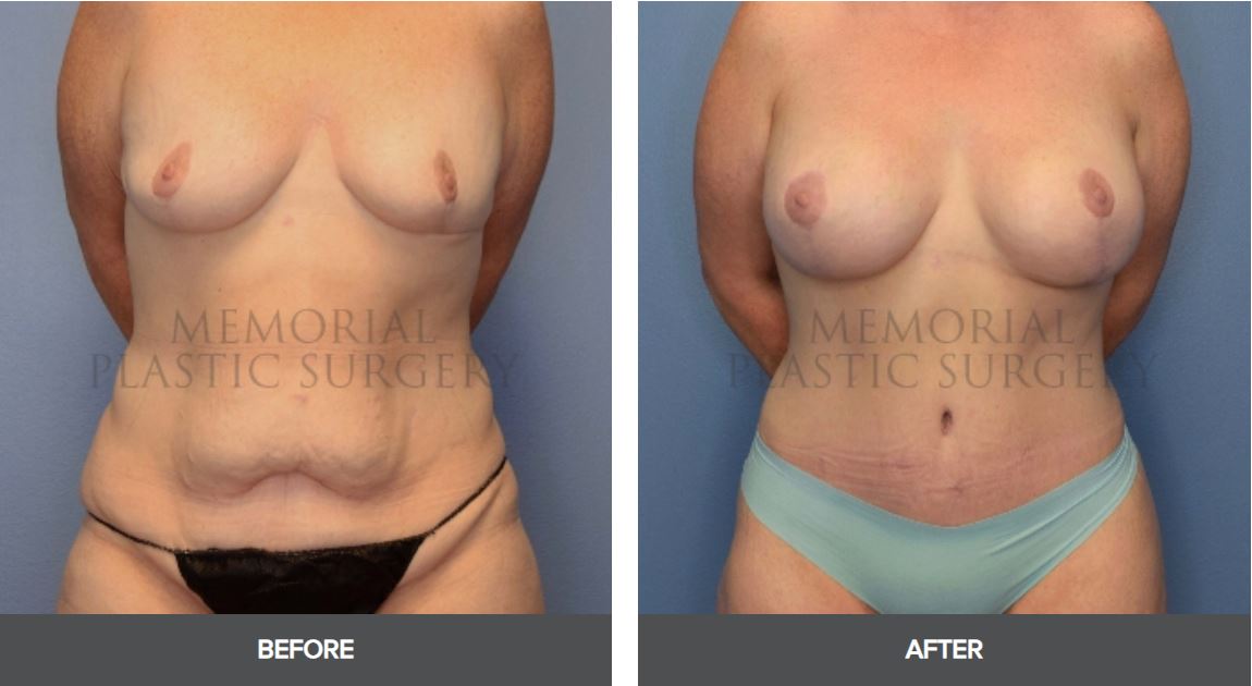 breast lift with implants patient - front view