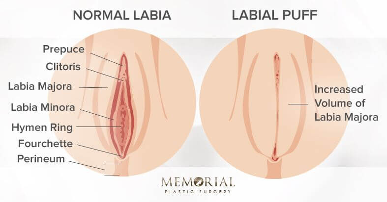 Labial Puff Before and After Diagram