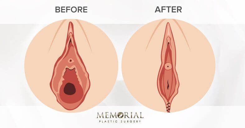 Vaginoplasty Before and After