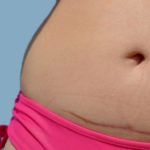 tummy tuck after c-section