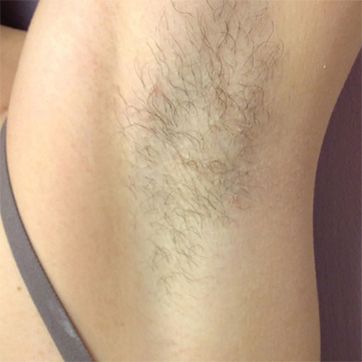 A photo of a patient before laser hair removal.