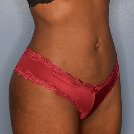 A photo of a patient after liposuction..