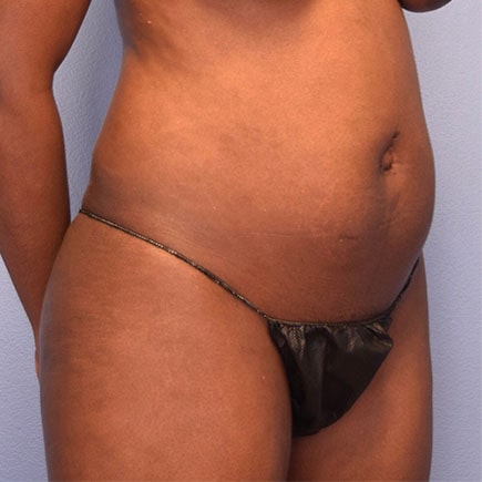 A photo of a patient before liposuction..