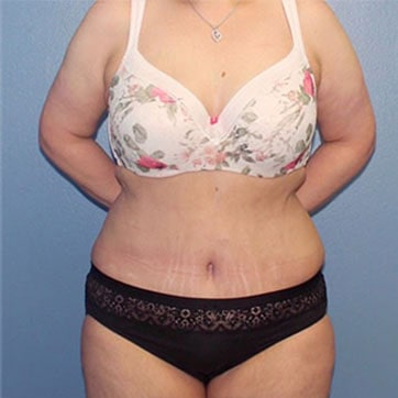 A front photo of a patient after tummy tuck.