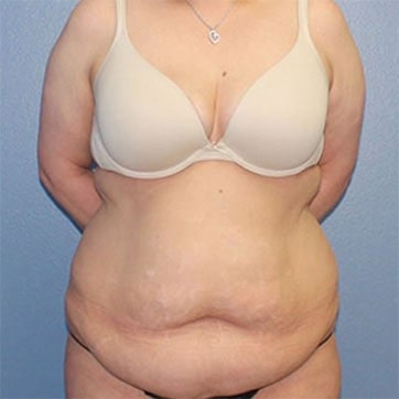 A front photo of a patient before tummy tuck.